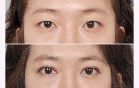 埋线双眼皮一般价位？北京哪个医院比较可靠？
