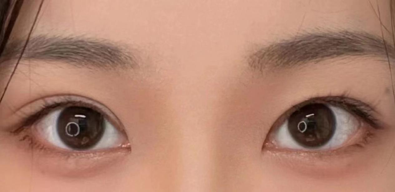 埋线双眼皮一般价位？北京哪个医院比较可靠？
