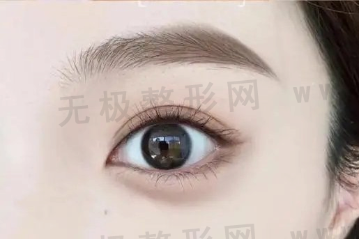 上海做开双眼皮需要多少钱？哪家医院做得好？