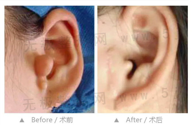 重庆哪家医院能做附耳切除术，重庆靠谱的整形医院