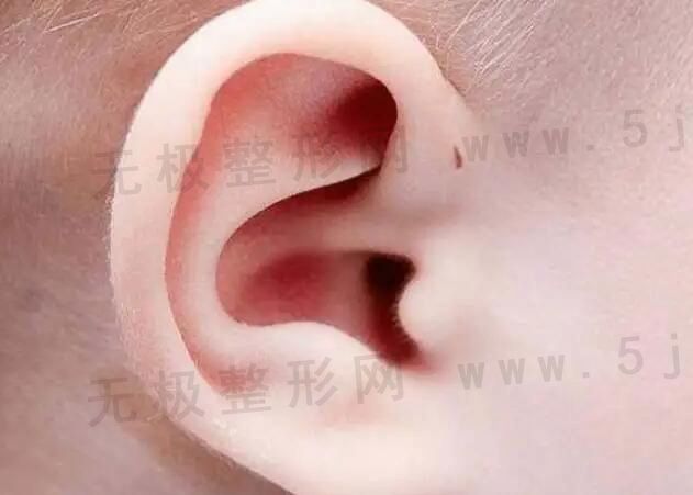 重庆哪家医院附耳切除手术做的好？切除附耳有风险吗？价格是多少钱？