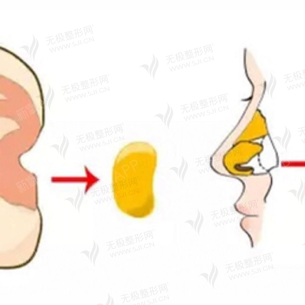 北京耳软骨垫鼻尖医院排名！2022耳软骨垫鼻尖多少钱？
