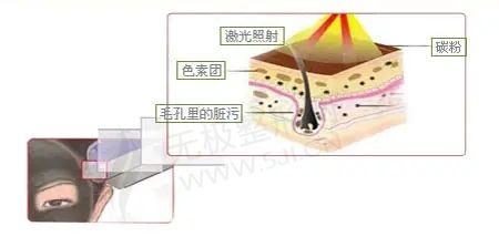 北京黑脸娃娃去痘印医院排名！2022黑脸娃娃去痘印多少钱？