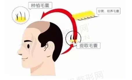 北京FUT种植头发医院排名！2022FUT种植头发多少钱？